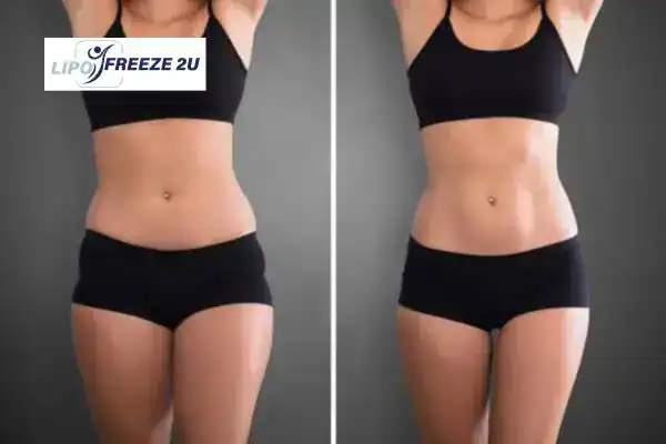 How Can LIPO FREEZE 2U Support Your Post-Pregnancy Body Recovery Bournemouth?