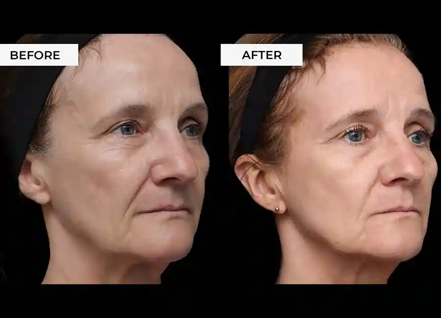 How Many RF Microneedling Sessions Will You Need to See a Difference Bournemouth?