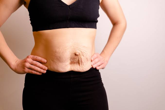 Is Surgery Really the Only Way to Repair Diastasis Recti Bournemouth?