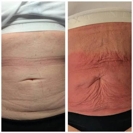 How Does RF Microneedling Improve Crepey, Thin and Uneven Skin Texture Bournemouth?
