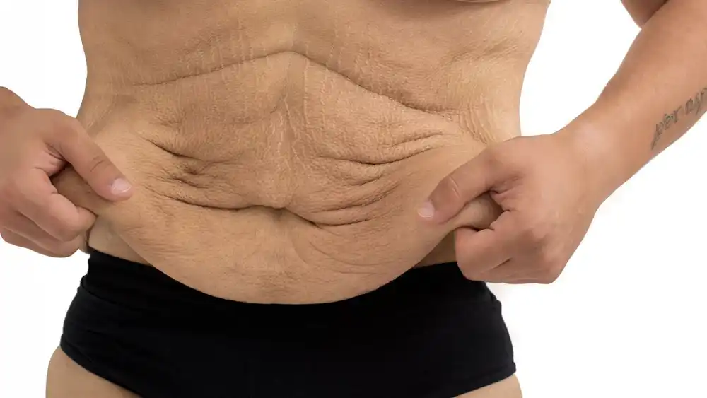 Why Does Weight Loss Medication Leave Some People With Loose or Sagging Skin Bournemouth?